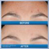 CeraVe Resurfacing Retinol Serum – Acne Marks & Pore Minimizer – 1 oz