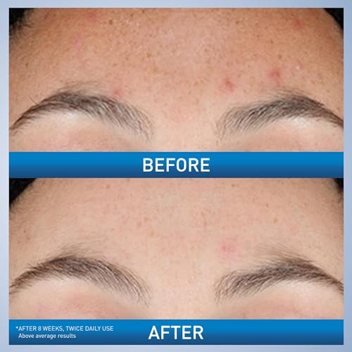 CeraVe Resurfacing Retinol Serum – Acne Marks & Pore Minimizer – 1 oz